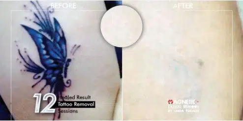 ASC_Skin_Magnetic_Tattoo_Removal_600x600