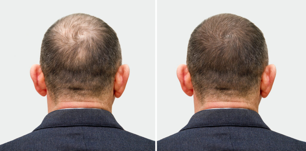 The head of a balding man before and after hair transplant surgery. A man losing his hair has become shaggy. An advertising poster for a hair transplant clinic. Treatment of baldness