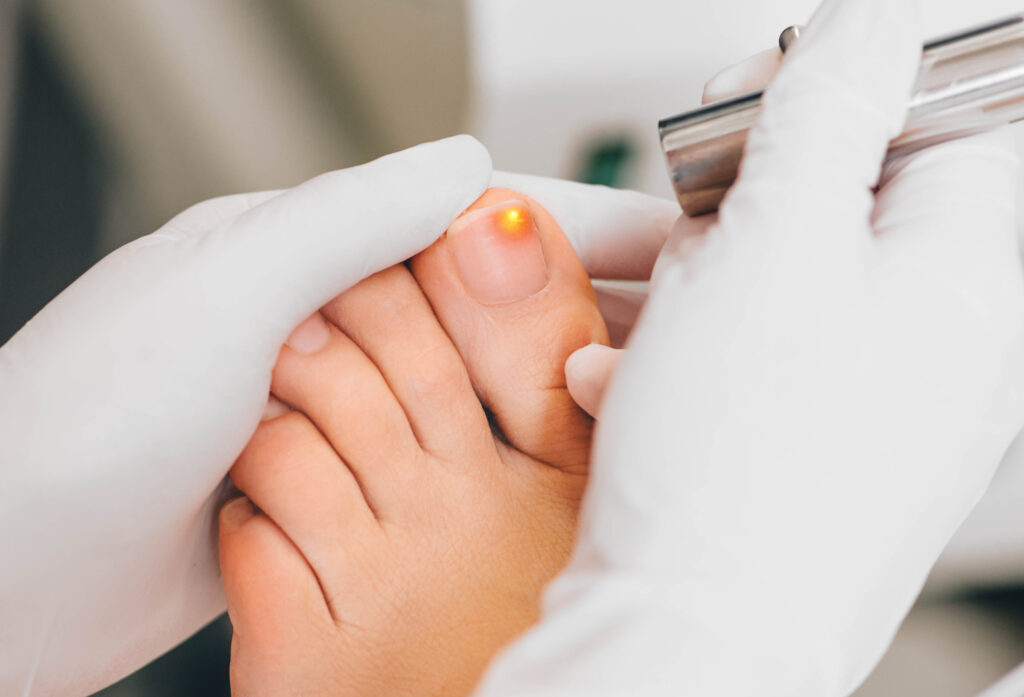 laser treatment on toenail, fungal infection on the toenails